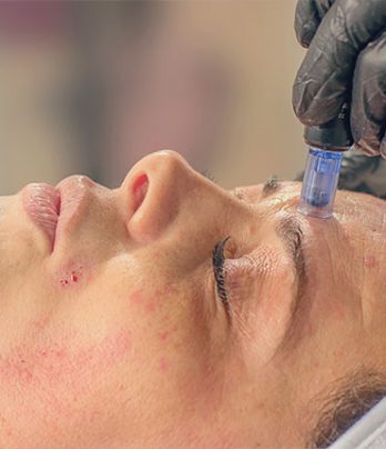 Microneedling