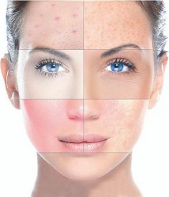 AI Skin Analyser